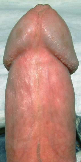 Results of frenuloplasty